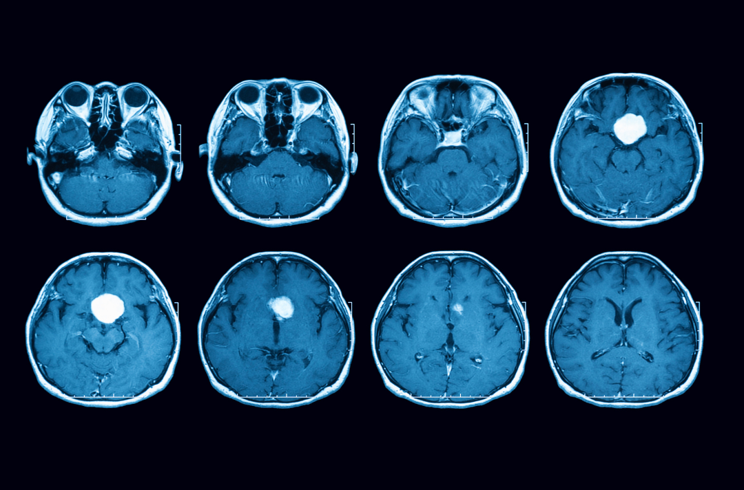 Advanced Therapies For Malignant Brain Tumors Hera Biolabs