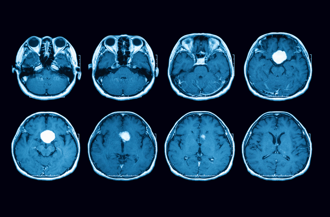 icd 9 code for malignant brain tumor